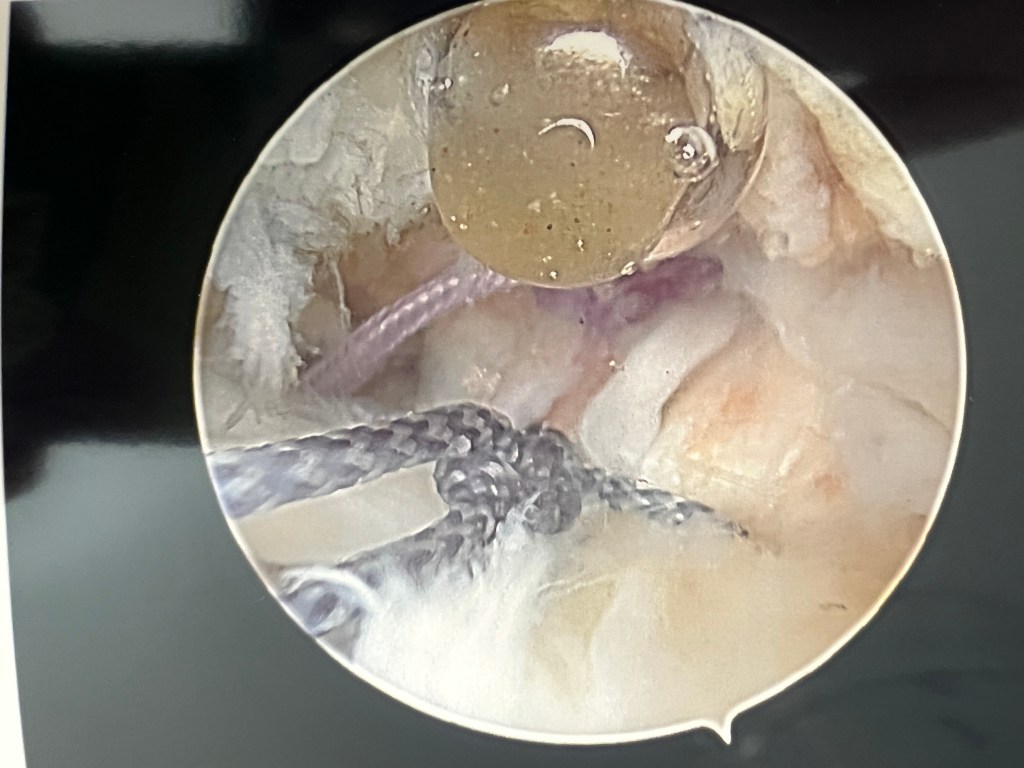 Close-up view of a surgical procedure, showcasing a tangle of sutures and tissue inside a joint or cavity.