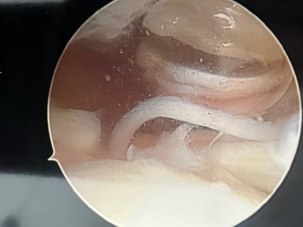Close-up view of an internal structure showing fluids and tissue in an anatomical context.